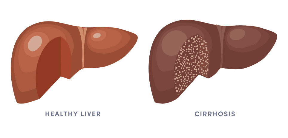 Picture of healthy and unhealthy livers