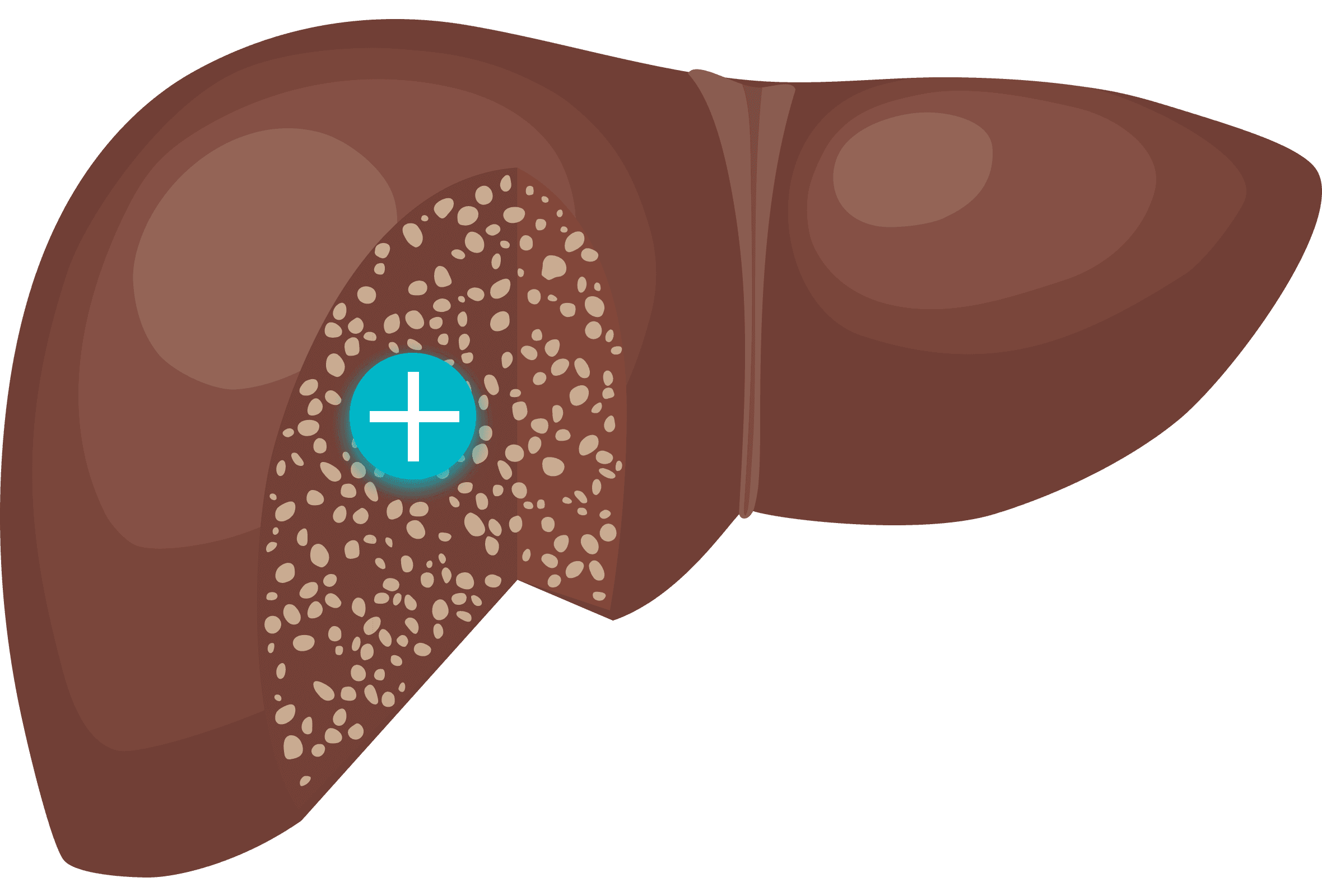 Image of cirrhosis liver