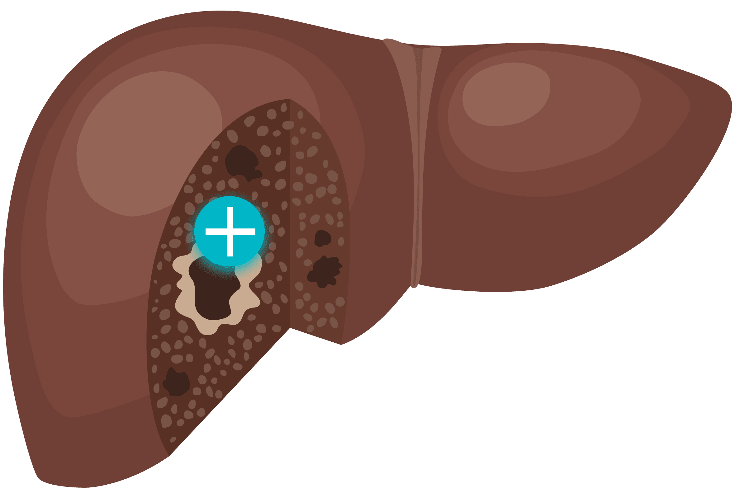 Image of liverCancer liver